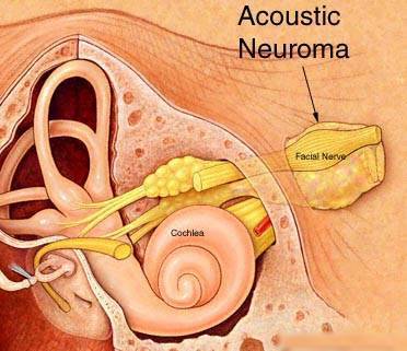Acoustic Neuroma Surgery Mumbai India, Acoustic Neuroma Origin, Acoustic Neuroma Surgery Delhi India