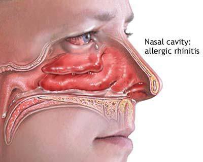 polyps in nose. and nasal polyps. Nose