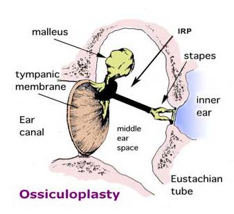  Best Ossiculoplasty Surgery Hospital India, Ossiculoplasty Operation, Ossiculoplasty Surgery Symptoms
