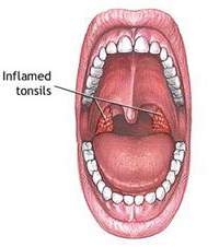 Tonsillectomy Surgery Bangalore India, Adenoidectomy, Intracapsular Tonsillectomy