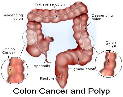 Colon Cancer, Cancer Of The Cervix Surgery, Colon Cancer Treatments, Colorectal Cancer Surgery