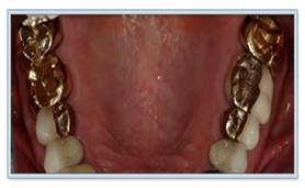 Dental Crowns India, Dental Crowns, India Dental Crowns Hospital, Tooth Whitening