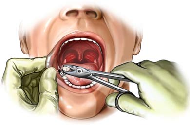 Cost Dental Extraction, Dental Extraction Treatment Mumbai India