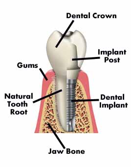 Implant Dentistry Treatment, Implant Dentistry Treatment India