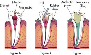 Painless Root Canal, Dental India, Best Root Canal Treatment Hospital India, Root Canal Treatment Symptoms
