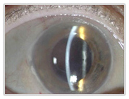 Cornea, Glaucoma, Cataract, Surgery, Descemets Stripping Endothelial Keratoplasty Treatment Mumbai Bangalore Delhi India