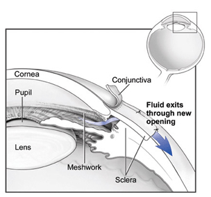 Glaucoma Treatment Delhi India, Low-Tension, Low-Tension Glaucoma, Optic Nerve, Acute Angle-Closure Glaucoma