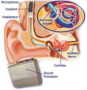 Cochlear Implant Surgery in India