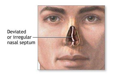 nasal cavity cancer