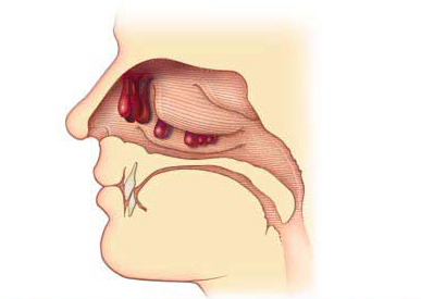  Nasal Polyp Removal Treatment, Nasal Polyp, Best Nasal Polyp Removal Surgery Hospital India