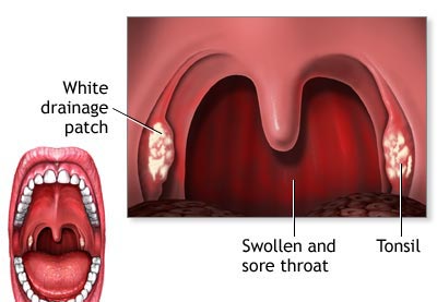 Sore Throat Surgery Mumbai India, Sore Throat, Sore Throat Surgery Delhi India