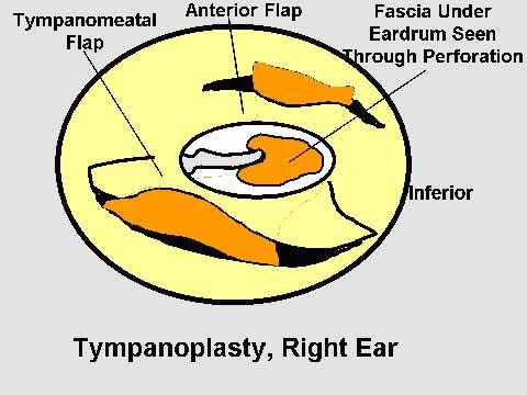 Tymanoplasty Eardrum Repair Surgery, India Tymanoplasty Eardrum Repair, Tympanoplasty, Eardrum Repair