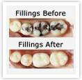 Dental Filling Treatment, Dental Filling Treatment India, Cost Dental Filling, Dental Filling, Dental Filling Treatment mumbai India, Dental Filling