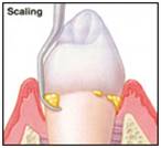 Dental Teeth Scaling, Dental Teeth Scaling India, Cost Dental Teeth Scaling, Dental