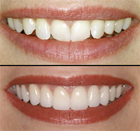 Teeth Whitening Treatment Delhi India, Teeth Whitening Treatment Bangalore India