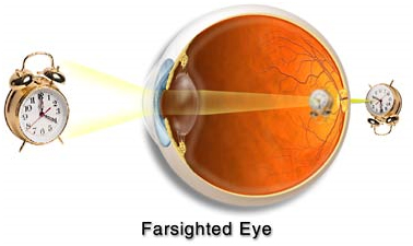 Laser Vision Treatment, Glasses, Contacts