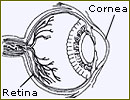 Eye Surgery Cornea India, Corneal Transplants India