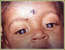 Strabismus Surgery Procedure, Resection Recession, Eye Muscles Misalignment