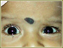 Eye Strabismus Surgery India, India Strabismus Treatment Cost Hospitals