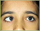 Strabismus, Diseases And Conditions Reference, Health Encyclopedia, Squint Your Eyes
