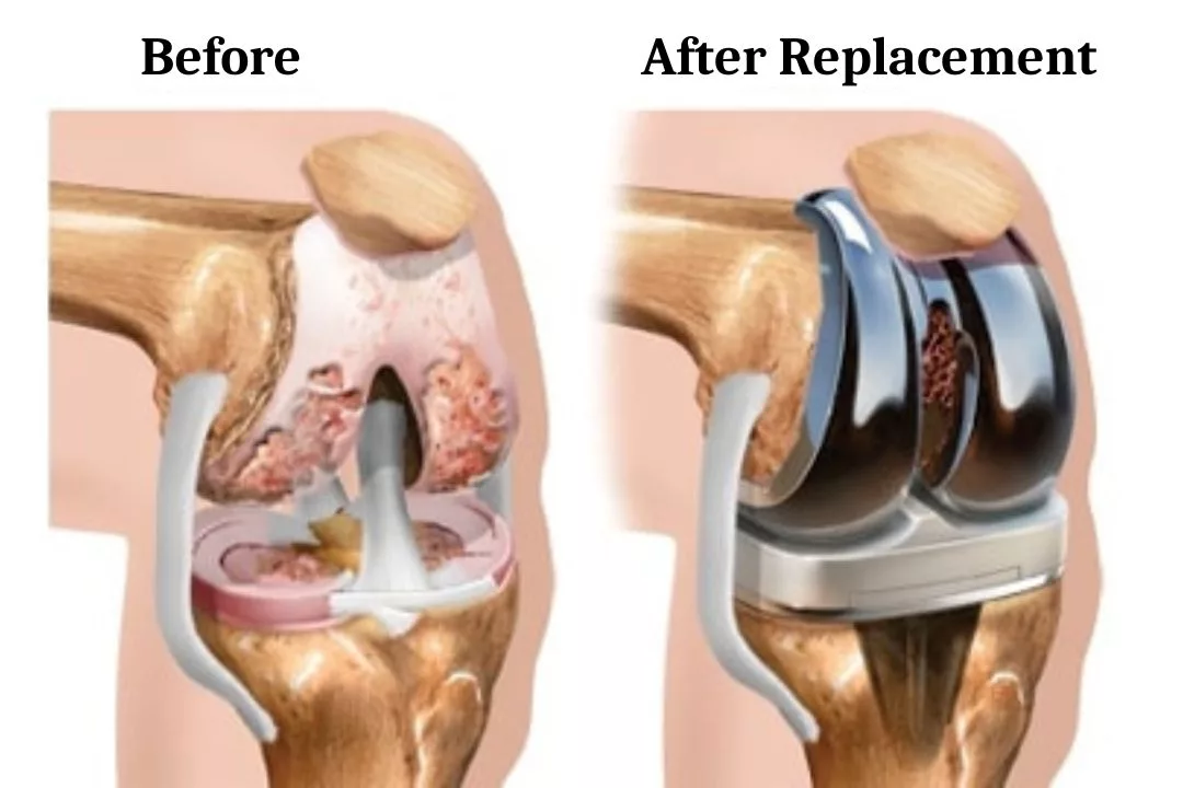 Total Knee Replacement (TKR)
