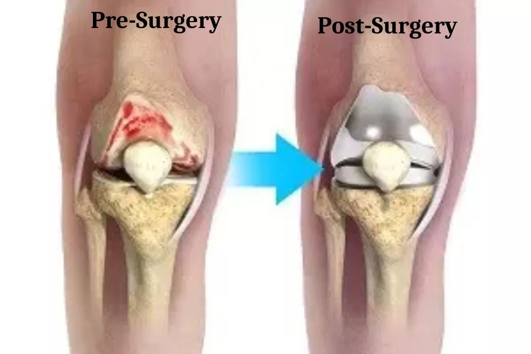 Revision Knee Replacement