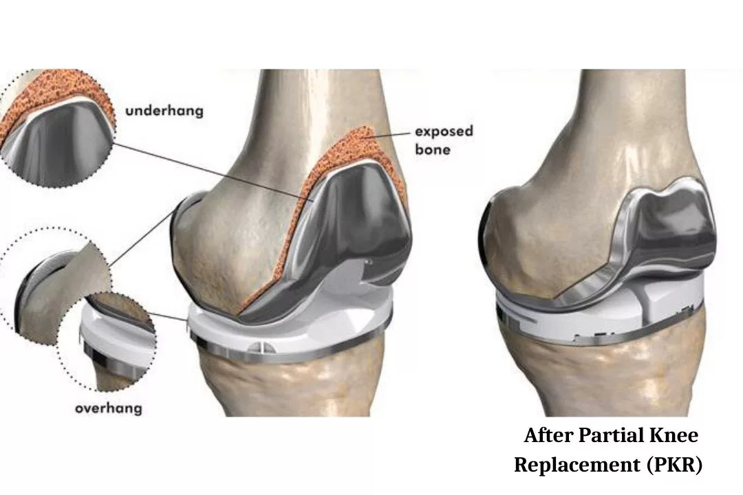 Partial Knee Replacement (PKR)