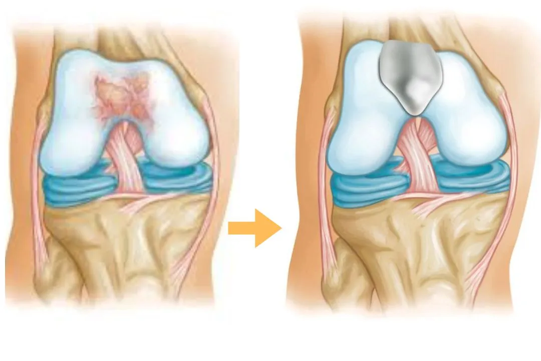 Knee Cap Replacement (Patellofemoral Replacement)