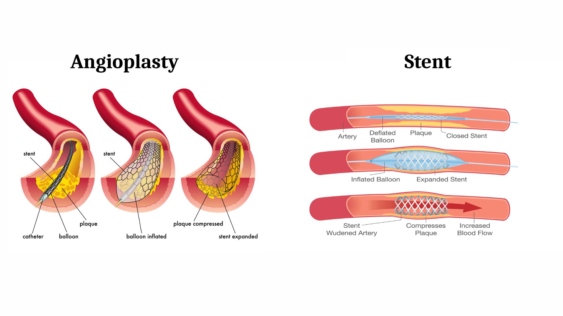 Angioplasty vs Stent