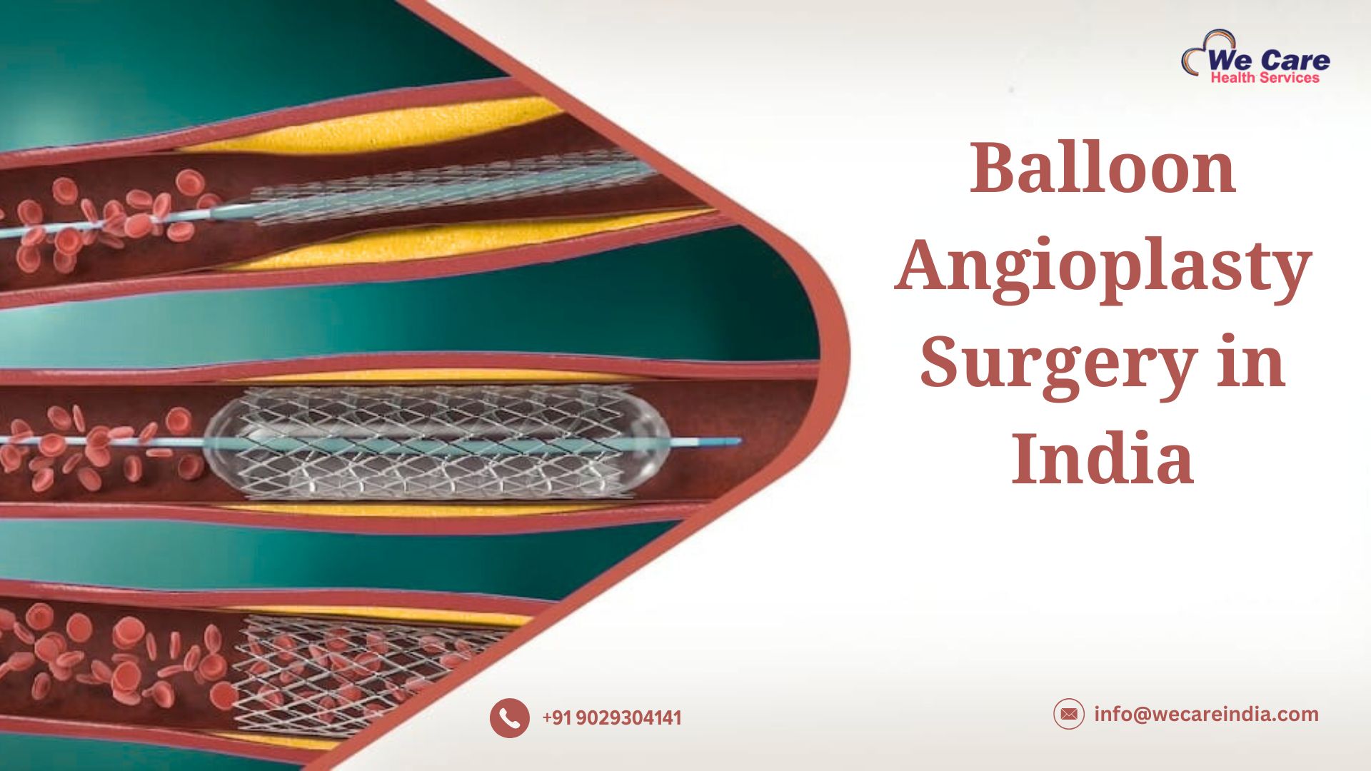Balloon Angioplasty Surgery in India