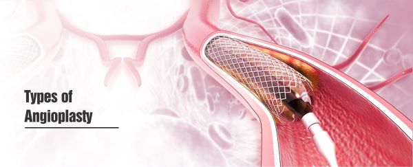 Types of Angioplasty