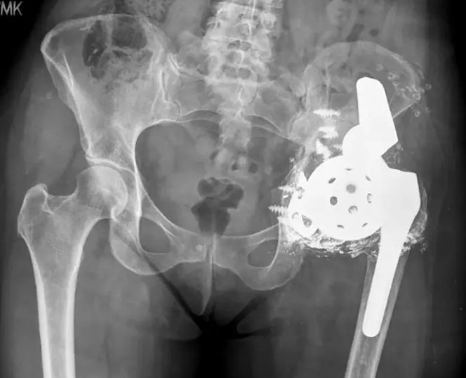 3-D Printed Implanted 