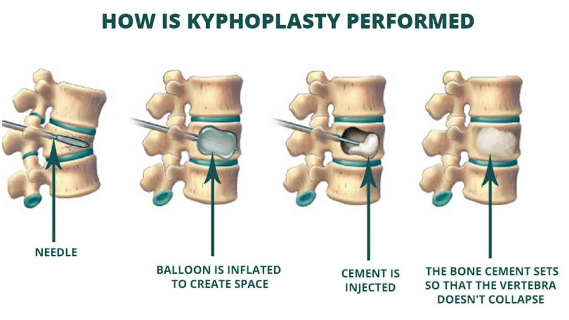 Kyphoplasty Over Other Procedures