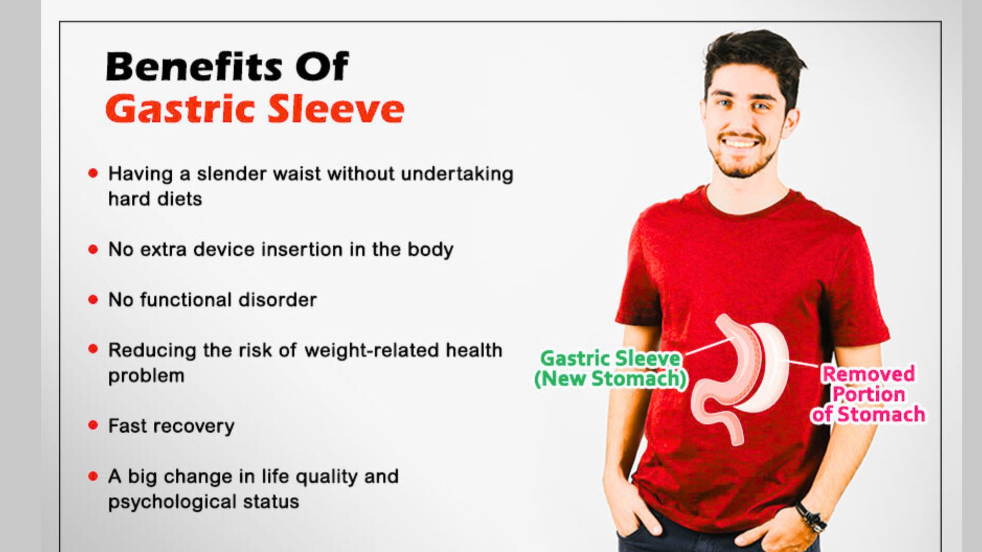 Benefits of Sleeve Gastrectomy Surgery