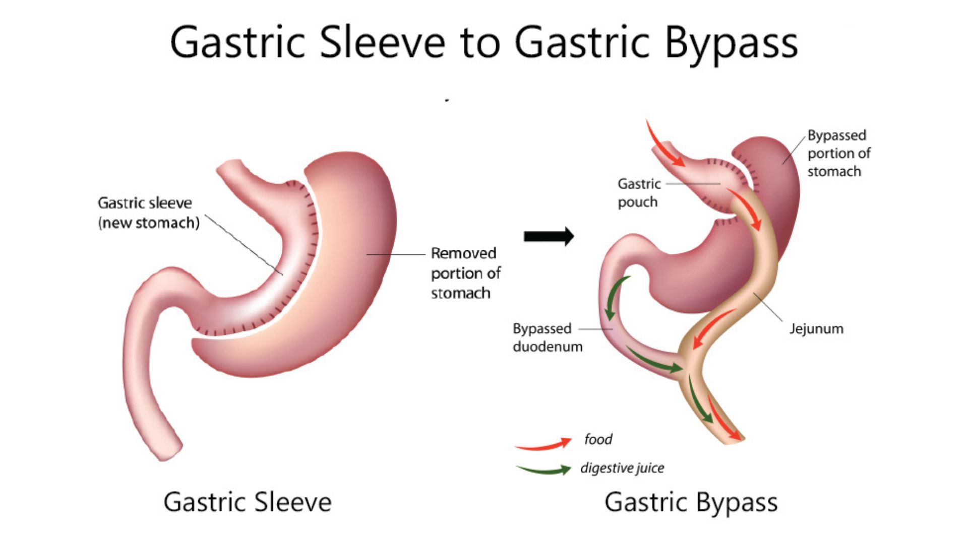 Gastric Bypass Surgery in India