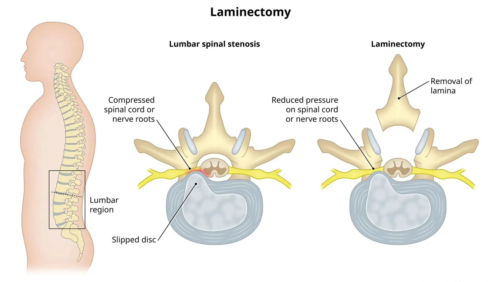 Laminectomy