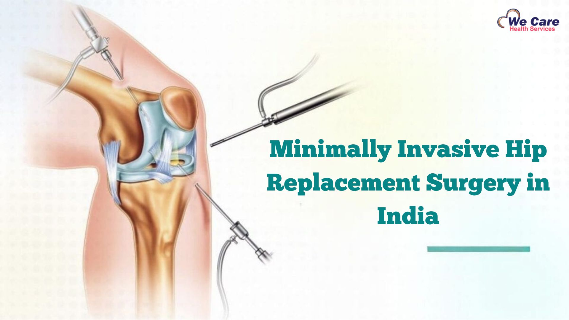 Minimally Invasive Hip Replacement Surgery in India