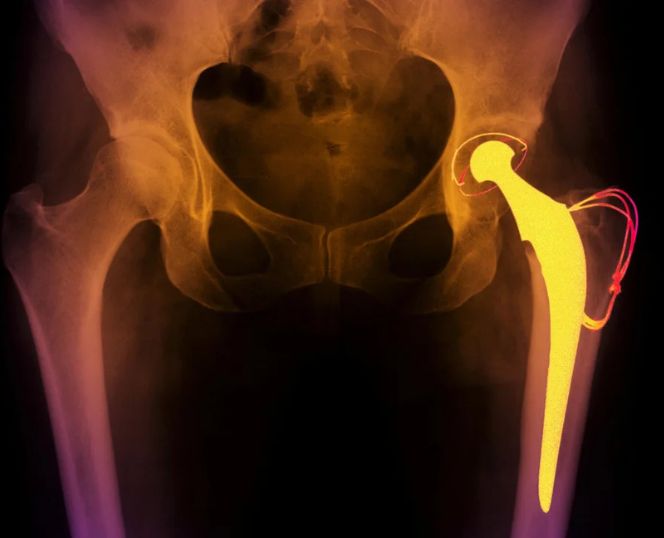 Smart Implants