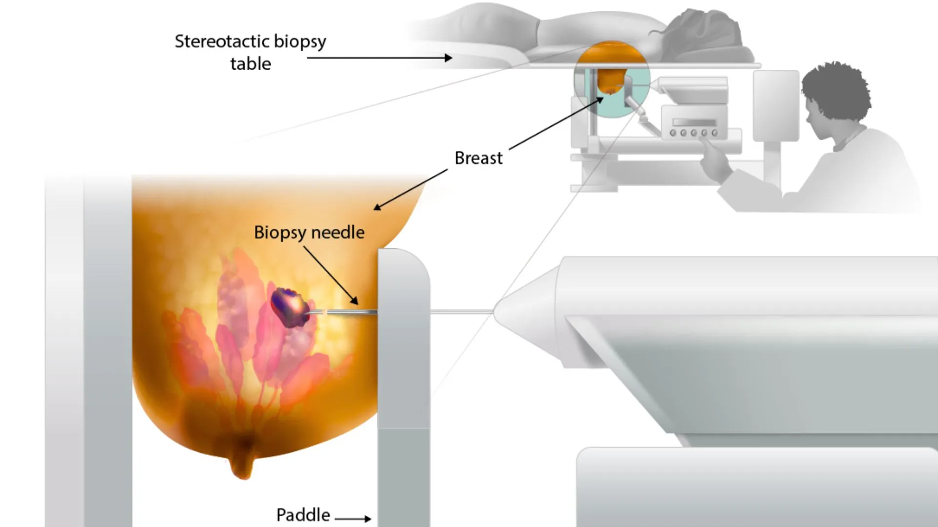 Stereotactic Biopsy