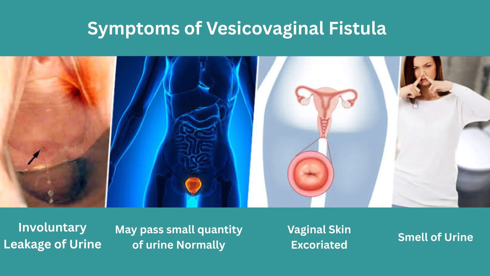 Symptoms of Vesicovaginal Fistula