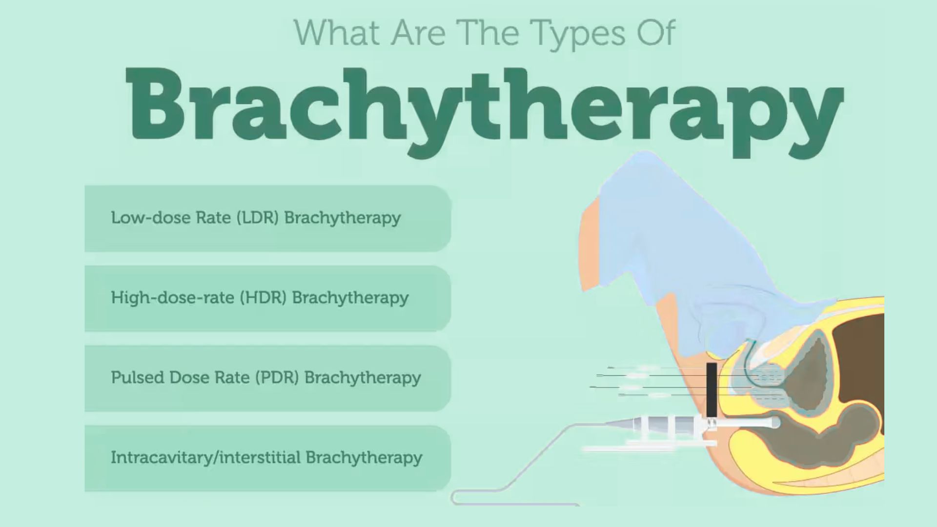 Types of Brachytherapy