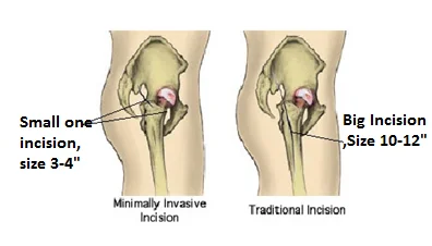 Minimally Invasive Hip Replacement vs Traditional