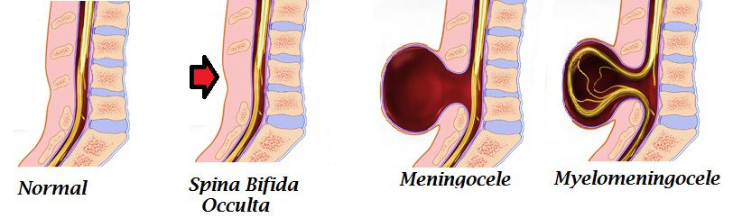Different Spina Bifida Types