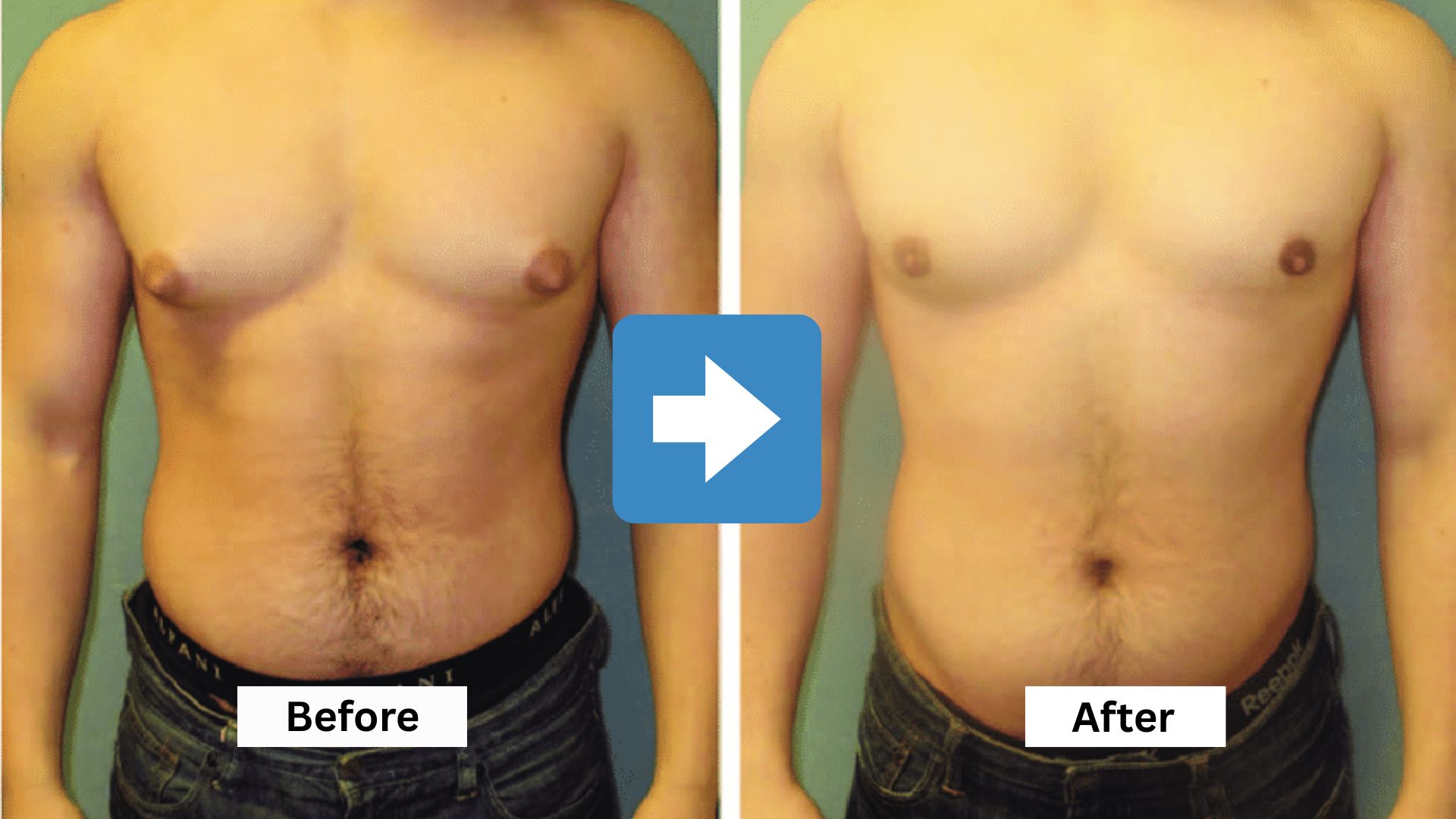 Gynecomastia Surgery
