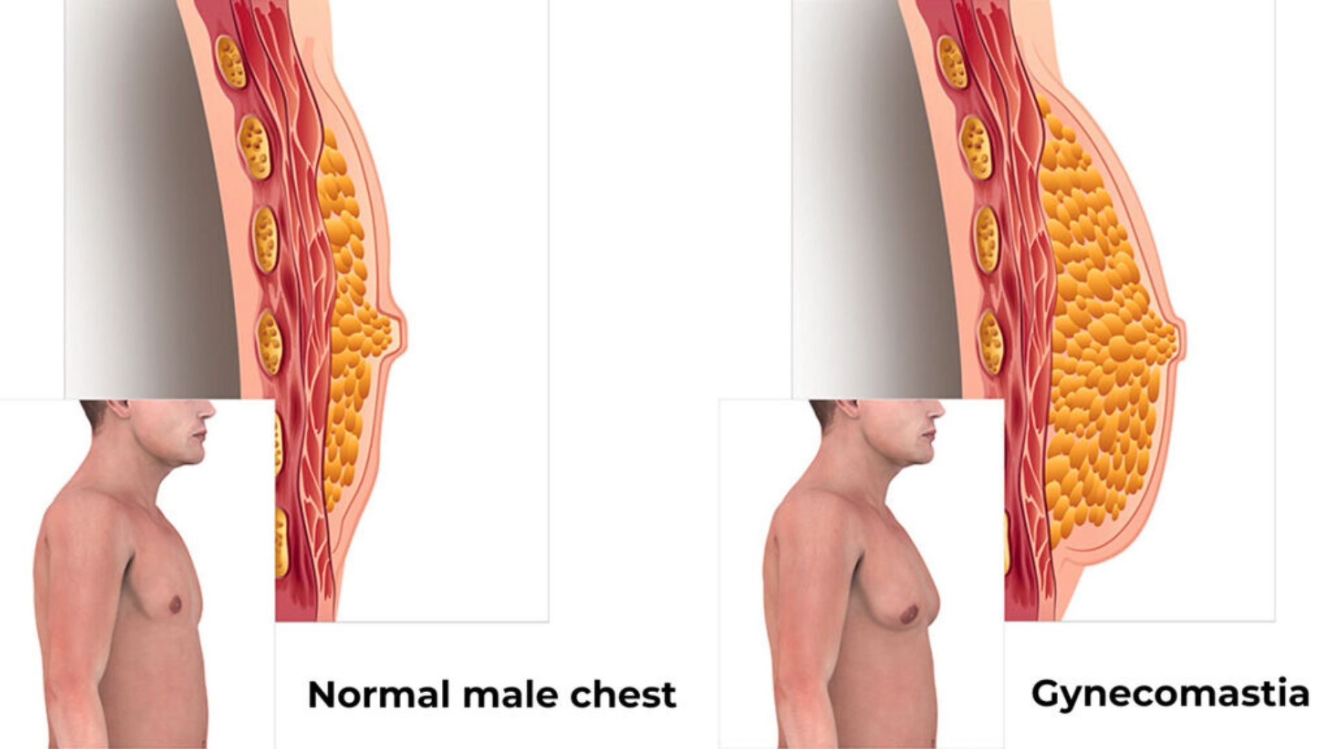 Gynecomastia Symptoms in Males