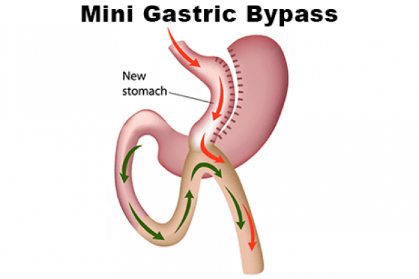 Mini Gastric Bypass Surgery