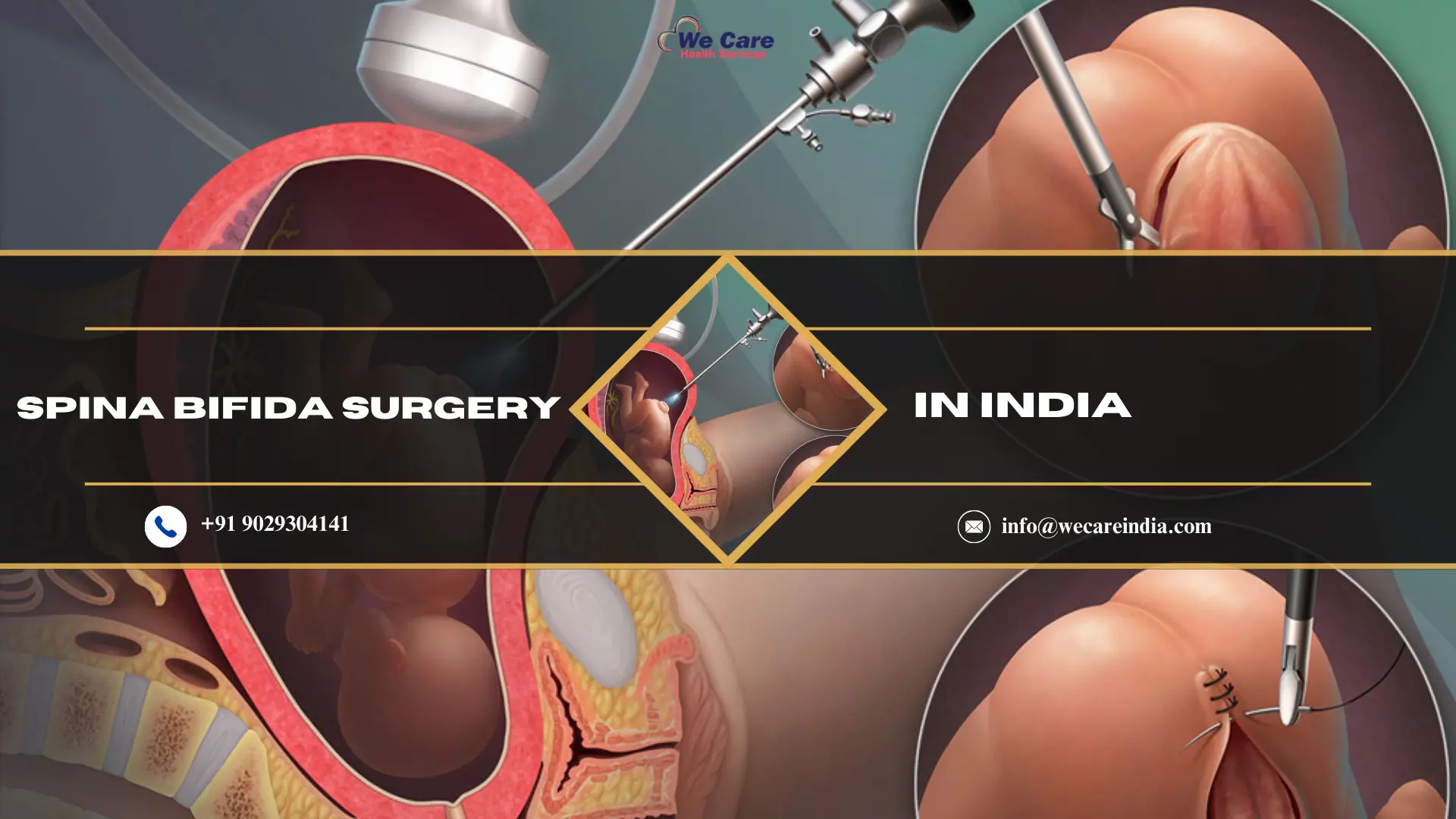 Spina Bifida Surgery in India