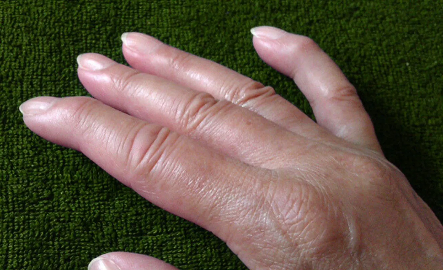 Finger Scleroderma Symptoms