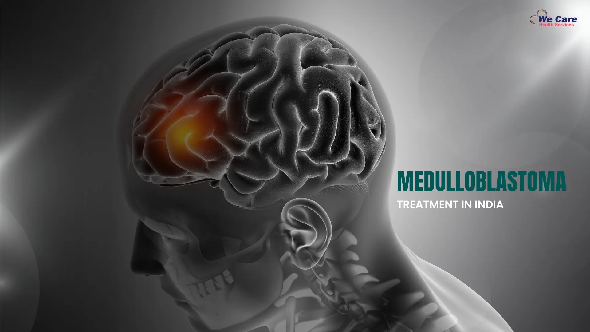 Medulloblastoma Treatment in India