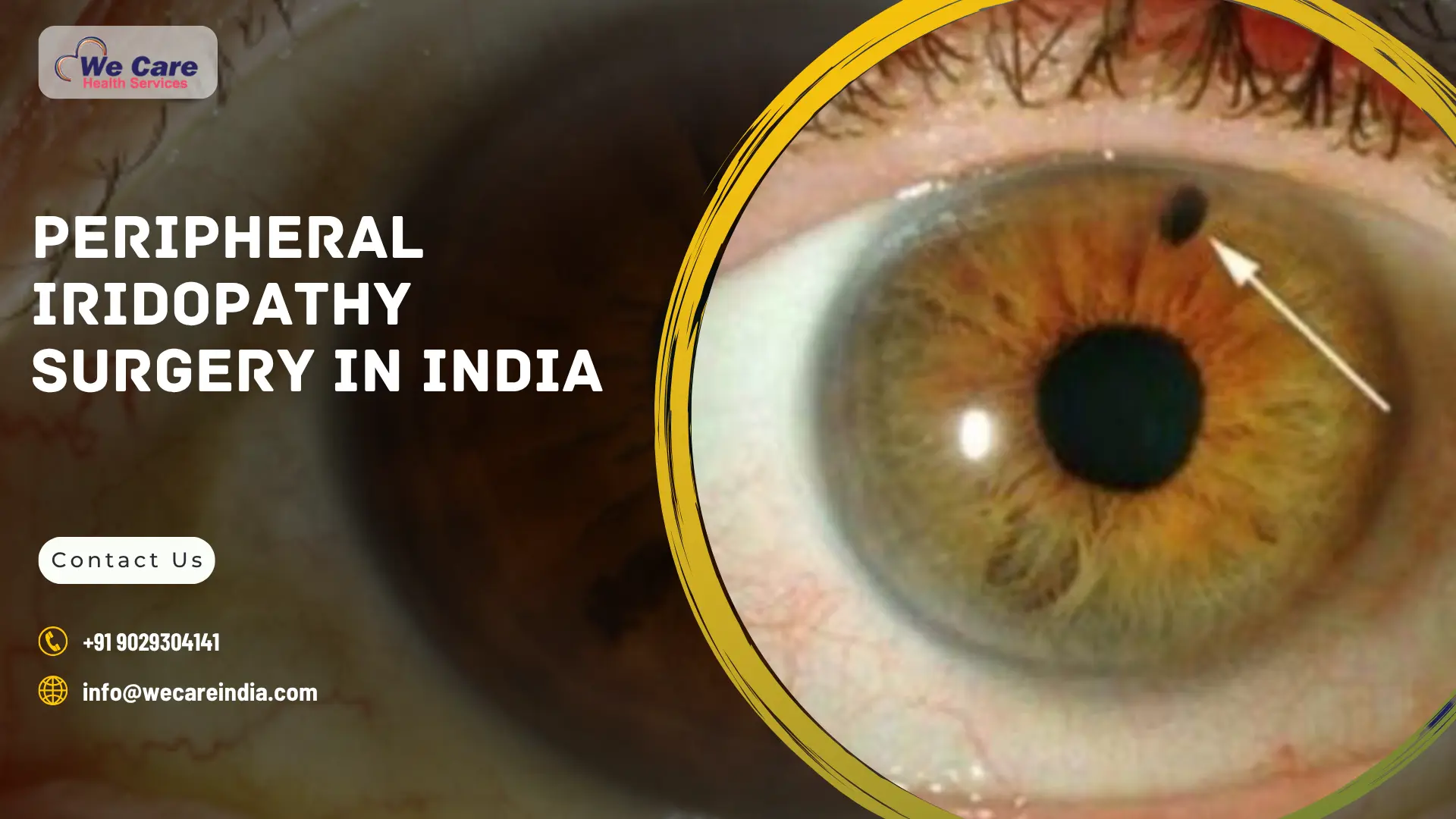 Peripheral Iridopathy Surgery in India